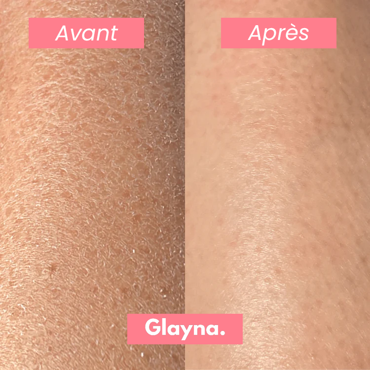 Gant Exfoliant Anti-Poils Incarnés